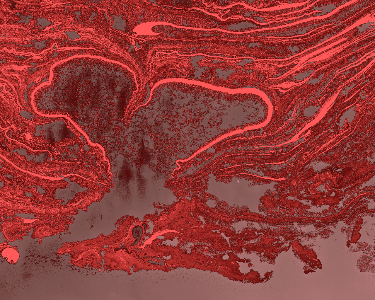Ilustración conceptual del remodelado vascular en las arterias del pulmón, empleada en la divulgación científica sobre la Hipertensión Arterial Pulmonar por Ferrer.