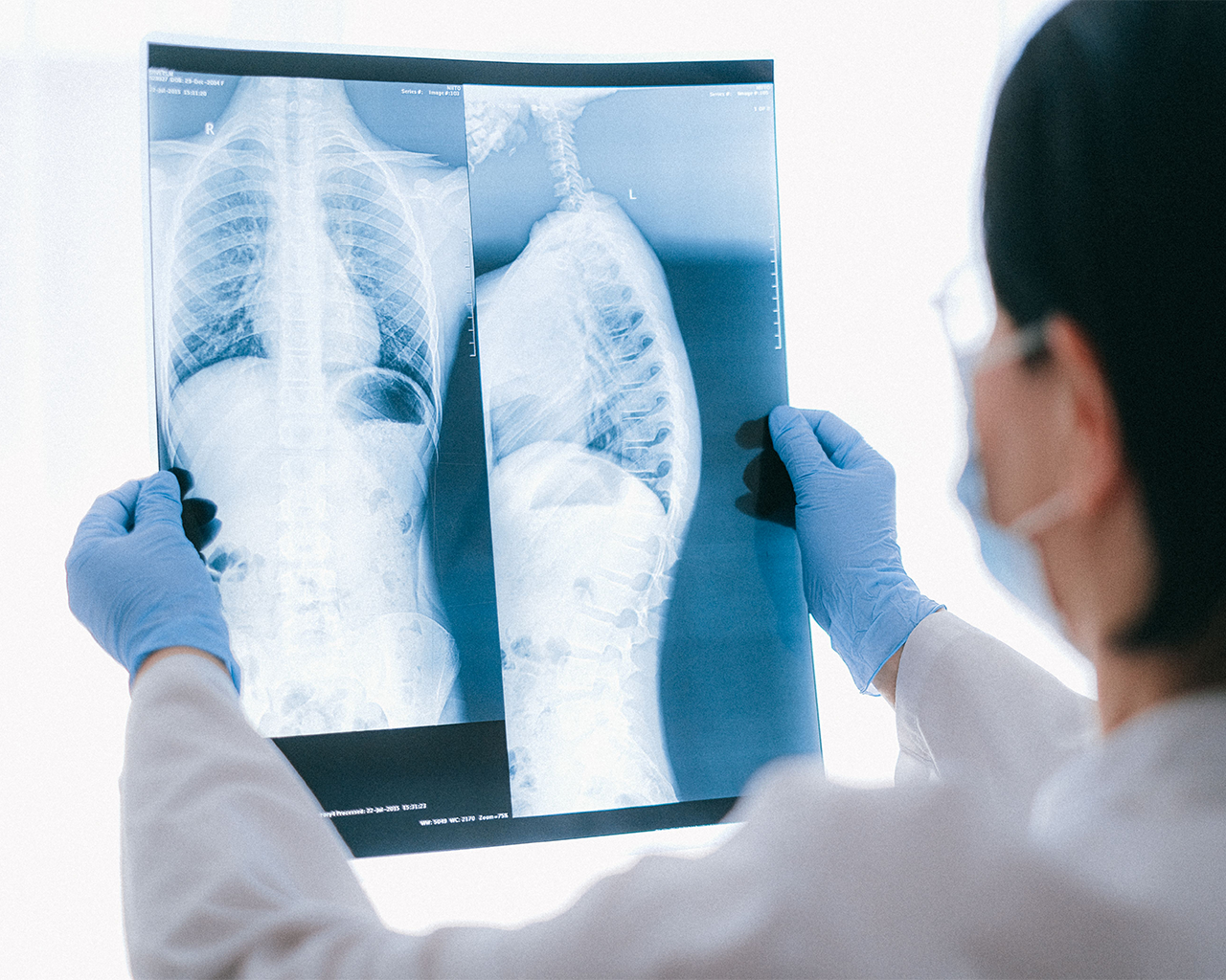 Vista des de l'espatlla d'una professional mèdica amb guants blaus i mascareta analitzant a contrallum una radiografia de tòrax i columna.