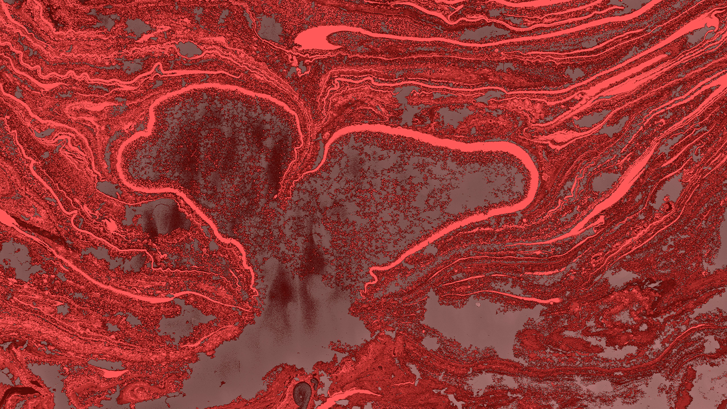 Ilustración conceptual del remodelado vascular en las arterias del pulmón, empleada en la divulgación científica sobre la Hipertensión Arterial Pulmonar por Ferrer.
