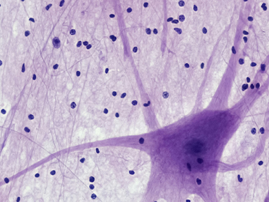 Neuronal tissue sample analyzed for the pharmacological investigation of Progressive Supranuclear Palsy in the Ferrer pipeline.